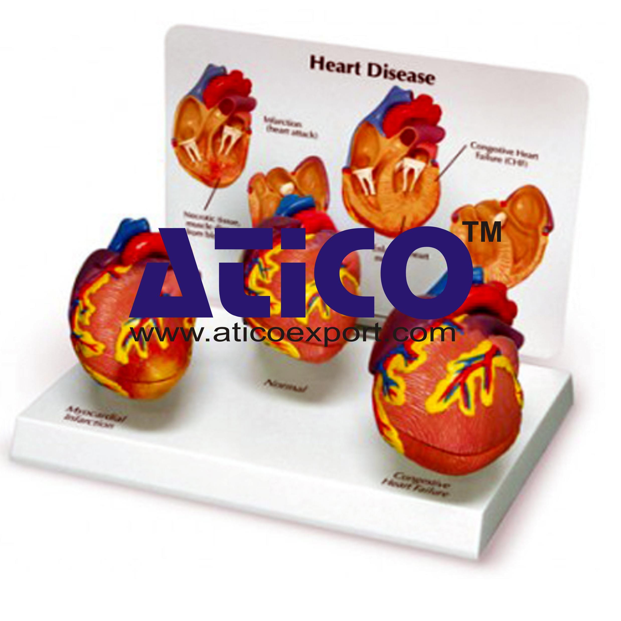 Heart Diseases Model